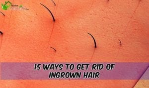 ingrown hairs on skin