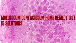 picture of molluscum contagiosum virus with heading over it