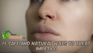 woman with impetigo on nose
