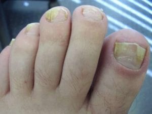 17 easy home remedies for nail fungal infections