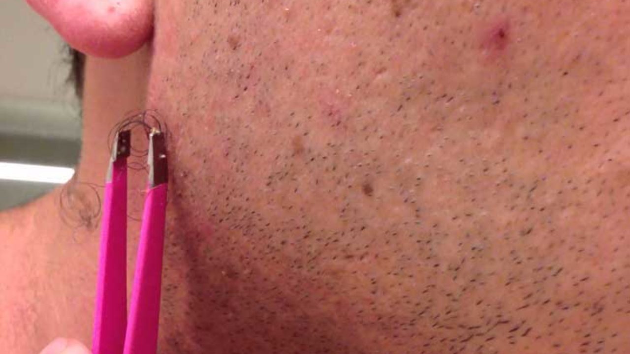 17 Home Remedies To Expose The Trapped Ingrown Hair Home Remedies