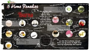 15 Home Remedies for Burns of Every Kind