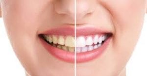 How to whiten teeth at home? It's easy with these guidelines.