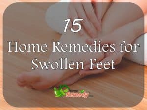 home remedies for swollen feet