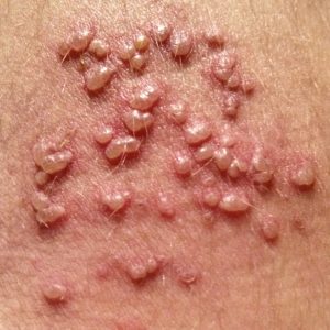 home remedies for shingles