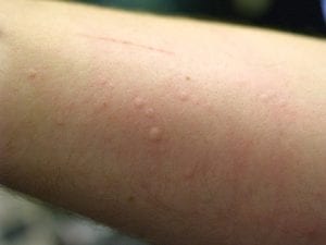 home remedies for hives on arm