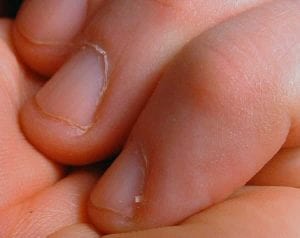 Dry Nails and Damaged Cuticles dry brittle nails