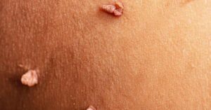 skin tag near anus