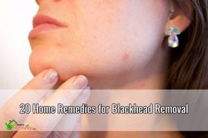 blackhead removal