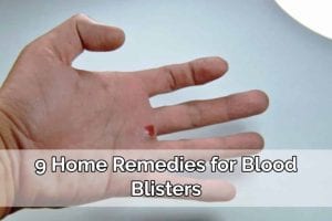 blood blisters