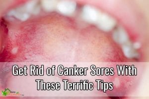 canker sore on tongue