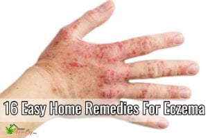 eczema on hands