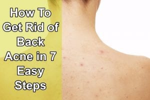 how to get rid of back acne