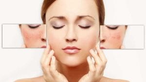 Redness in face can be caused by rosacea