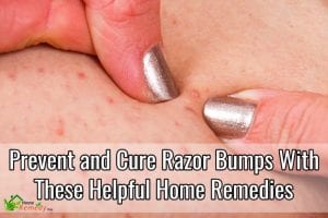 how to prevent razor bumps