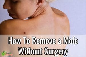 how to remove a mole