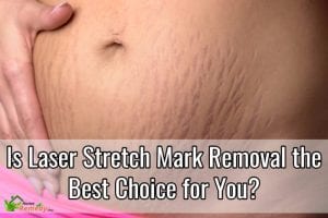 laser stretch mark removal